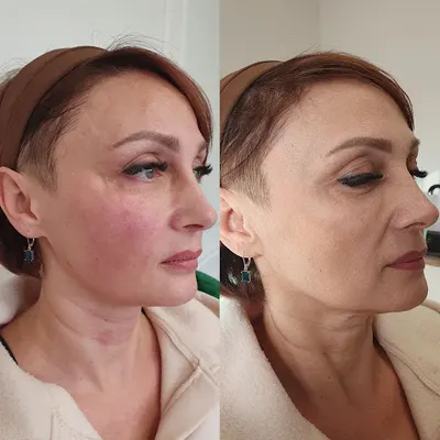 Klinika DermaElite. Trychologia , Włosy i Medycyna Estetyczna